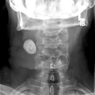 x-ray-of-salivary-stone