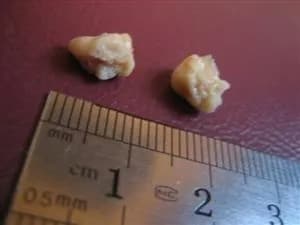Tonsil stones shown with ruler to show size