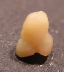 Tonsil stone