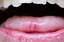 canker sores on the tongue