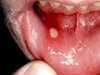 canker sore picture 1