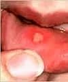 canker sore picture 3