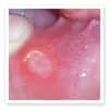 canker sore picture 5