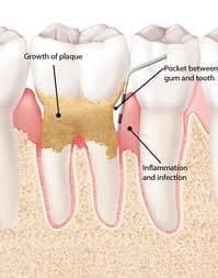 dental plaque diagram / image credit DrBlazer.com