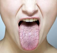 Cracked tongue