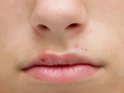 Canker Sores on the Lip
