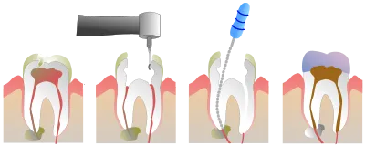 root-canal-process-diagram