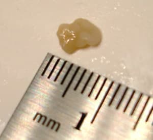 actual tonsil stone that measures 6 millimeters in diameter