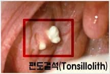 tonsil stone picture 2