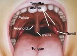 Tonsil infections that lead to chronic bad breath are most often due to tonsil stones. Although tonsil stones are fairly common, many dentists and physicians miss them completely when their patients complain of halitosis.