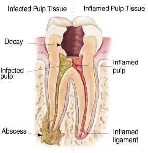 tooth-abscess-diagram
