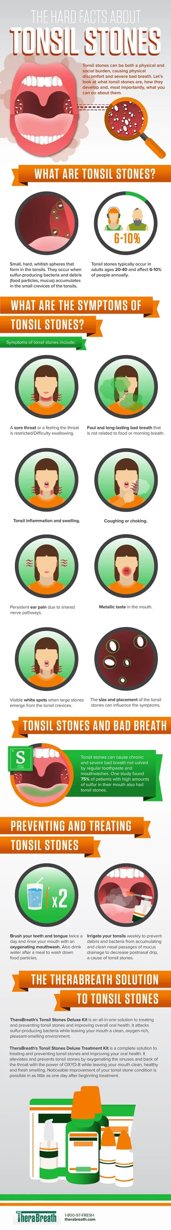 Full-size image of the The Hard Facts about Tonsil Stones infographic