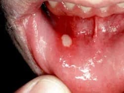 Canker sore on inner bottom lip