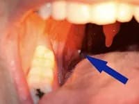 Pointing to a tonsil stone at the back of the mouth