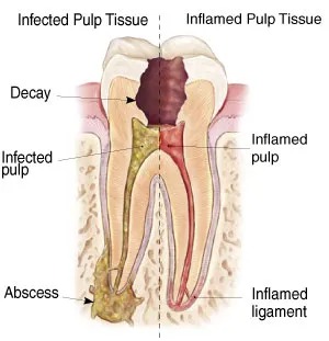 Tooth abscess diagram